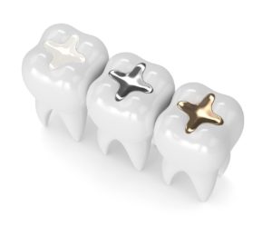 Examples of Inlays